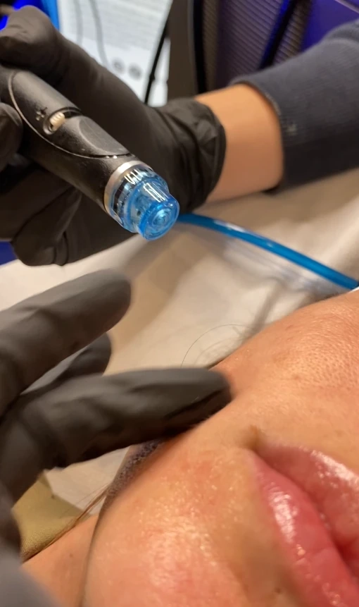 Hydrafacial un soin idéal pour l'été