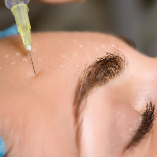 Mésothérapie et skinbooster - Clinic 26
