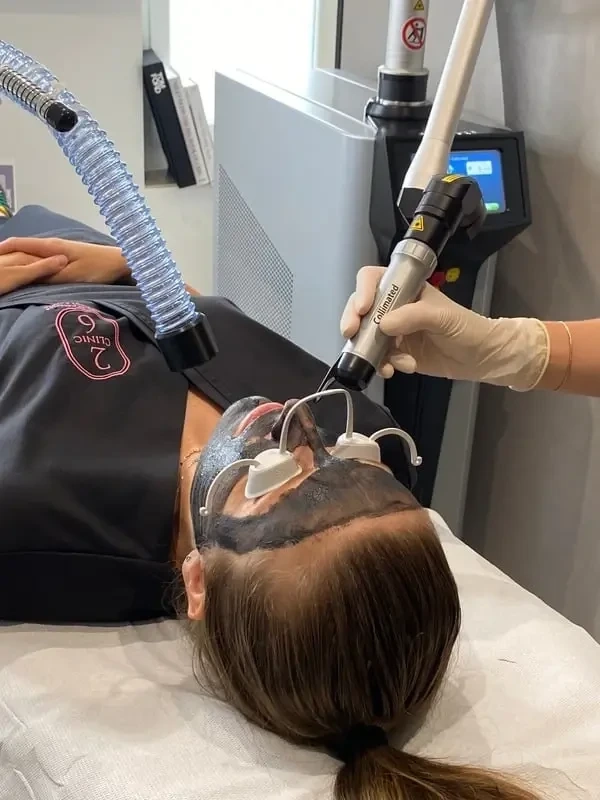Carbon Peel - Clinic 26