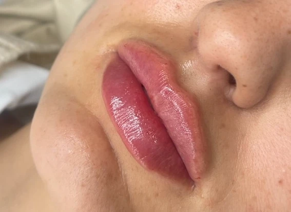 Technique d'injections : le Russian lips