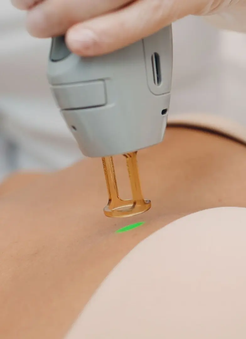 Détatouage au laser