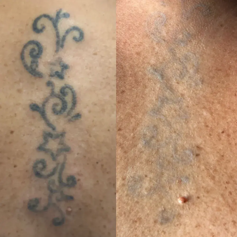 Tatouage avant / après détatouage laser