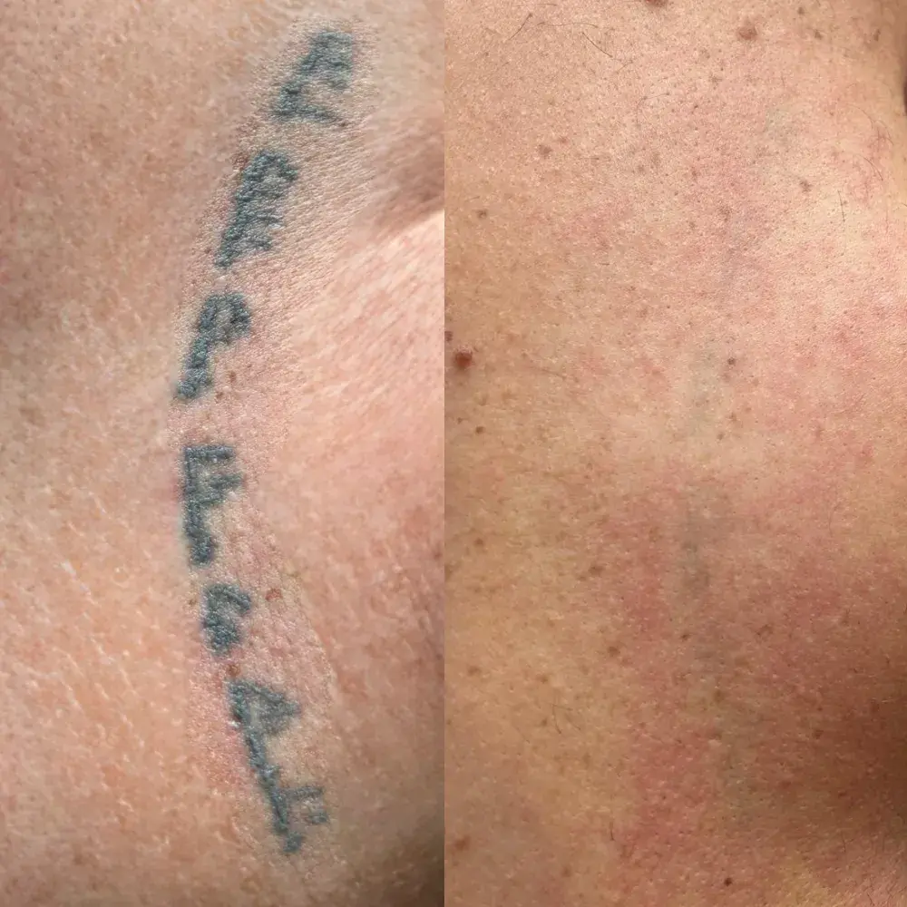 Tatouage avant / après détatouage laser