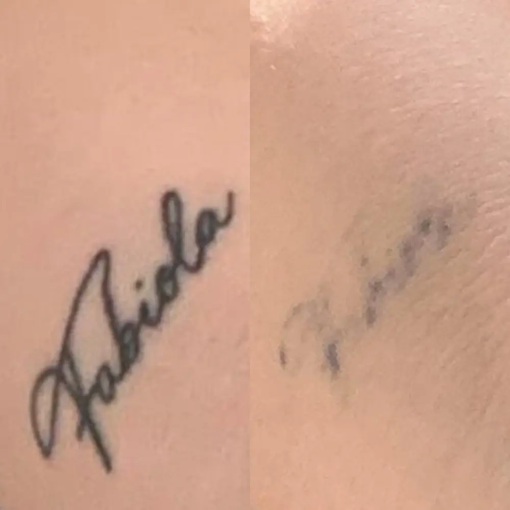 Tatouage avant / après détatouage laser