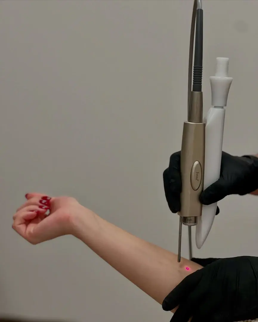 Détatouage sur avant bras