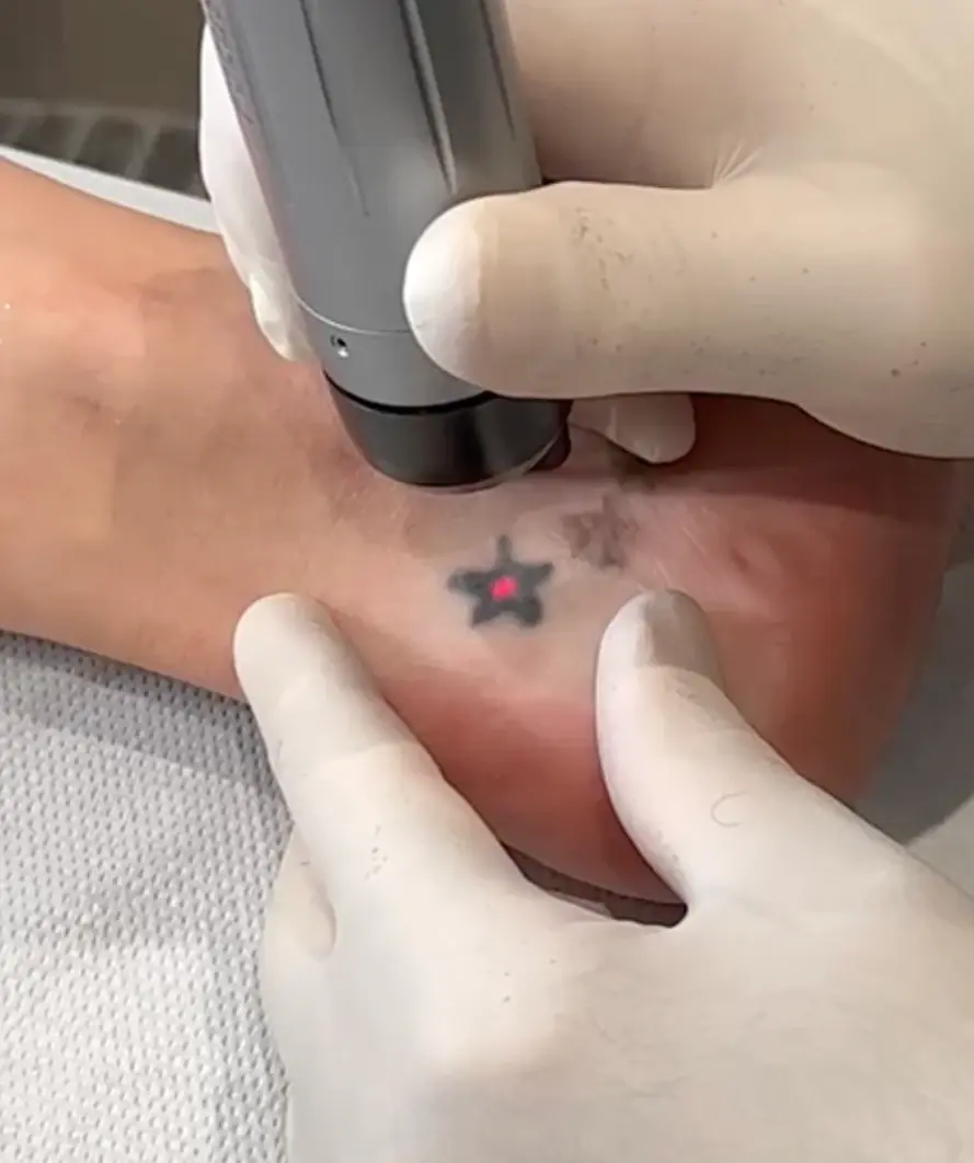 cheville tatouée se faisant détatouée au laser