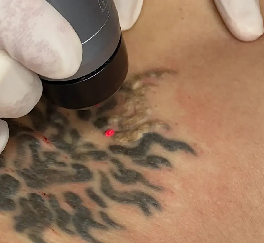 Détatouage au laser
