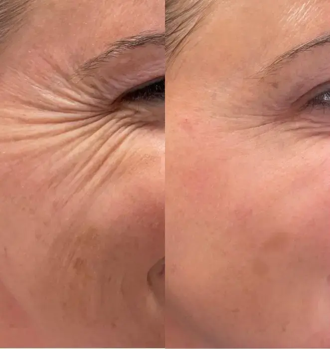 Résultats d'injection de botox sur les rides de l'oeil - Clinic 26
