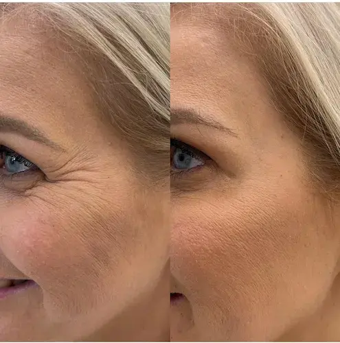 avant-après inducteur de collagène - Clinic 26