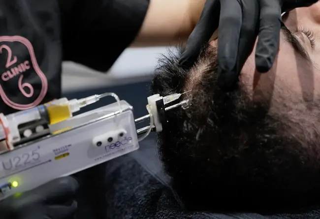 Image de Mésothérapie capillaire