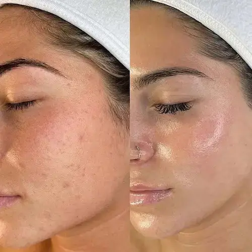 Avant-après soin microneedling peau lumineuse - Clinic 26