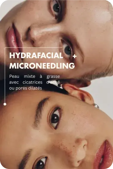 Illustration hydrafacial microneedling