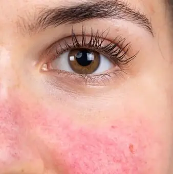 Peau avant peeling - Clinic 26