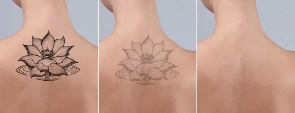 Trois images du même dos avec un tatouage de plus en plus effacé