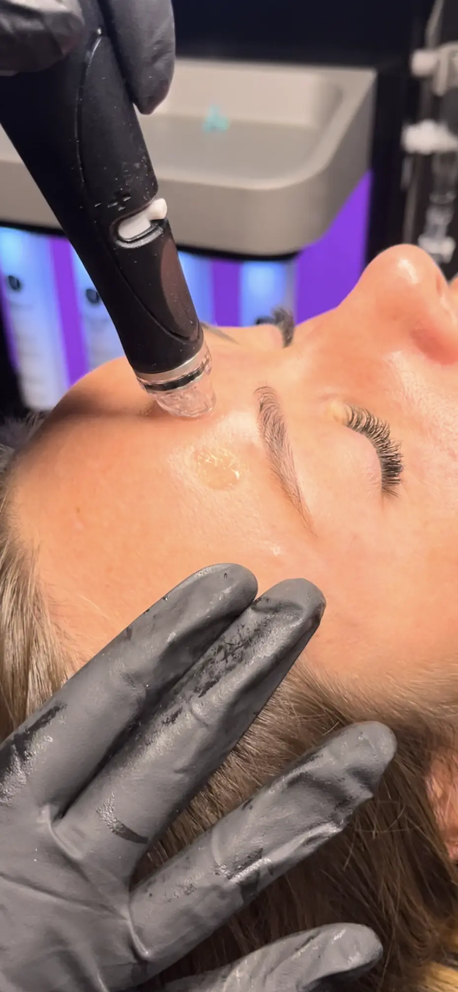 Séance d'hydrafacial sur front