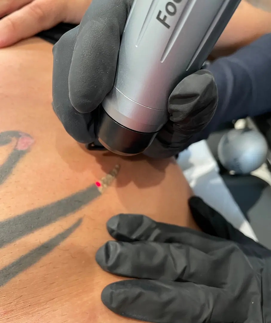 Détatouage dos homme - Clinic 26