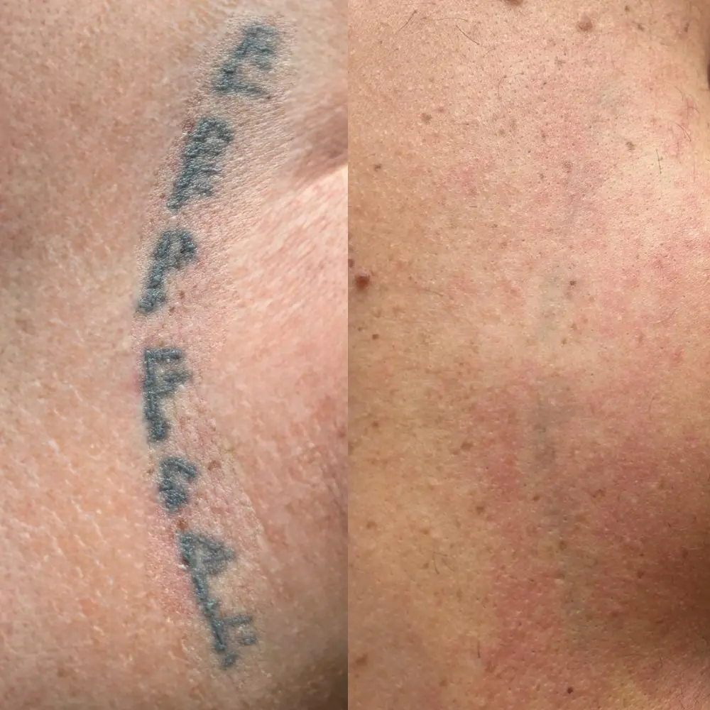 Détatouage avant/aprés - Clinic 26